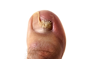 What That Discolored Toenail Could Really Mean